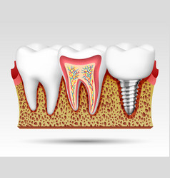 3d Teeth In A Cut With Nerve Endings