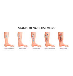 Stages Of Varicose Veins