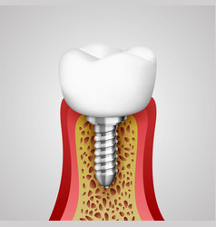 3d Teeth In A Cut With Nerve Endings