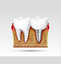 3d Teeth In A Cut With Nerve Endings