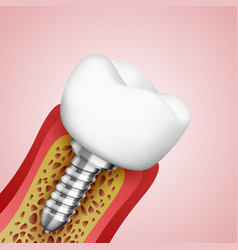 3d Teeth In A Cut With Nerve Endings