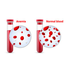 Anemia Problem Circulatory Iron Body Diagram