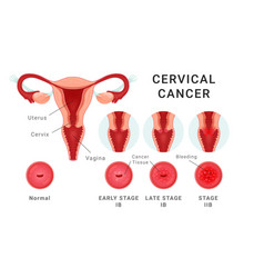 Cervical Cancer Stage Medical Healthcare