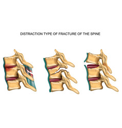 Distraction Type Fracture Spine