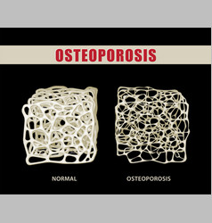 3d Comparing Osteoporosis With Normal Bone