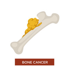 Bone Cancer Tumor And Oncology Marrow Disease