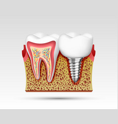 3d Teeth In A Cut With Nerve Endings