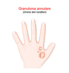 Granuloma Annulare Chronic Skin Condition