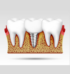 3d Teeth In A Cut With Nerve Endings