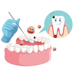 Dentist Hand With Human Teeth Decay Model