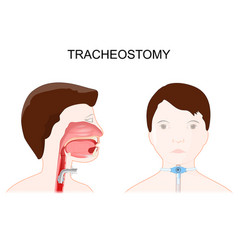 Tracheotomy Side View Of The Neck And Placement