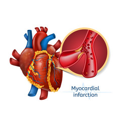 Atherosclerosis stages heart strokes thrombus Vector Image