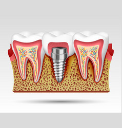 3d Teeth In A Cut With Nerve Endings