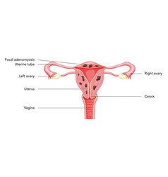 Adenomyosis Focal With Inscriptions Human Anatomy