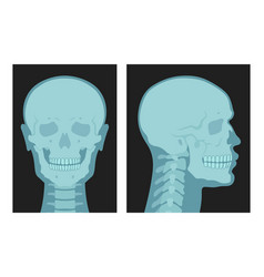 X Rays Shots Of Human Skull Front Side View Set