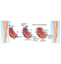 Edema In Inflammation