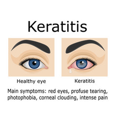 Keratitis Disease