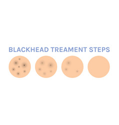 Blackheads On Human Skin Problem Treatment