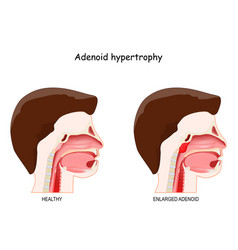 Adenoid Hypertrophy