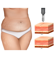 Stretch Mark Removal Striae Or Distensae