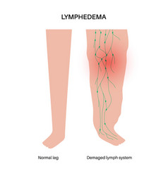 Lymphedema Leg Swelling