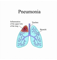 Pneumonia The anatomical structure of the human Vector Image