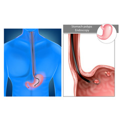 Gastric Polyps Stomach Upper Endoscopy