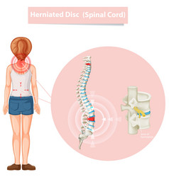 Diagram Showing Herniated Disc