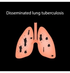 Disseminated Tuberculosis