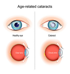 Cataracts Age-related Vision Problems