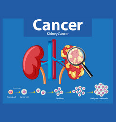 Cancer Development Process In Human Kidney