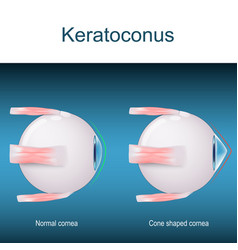 Keratoconus Eyes Disorder