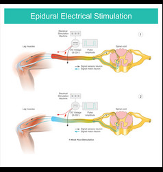 Epidural Electrical Stimulation Muscle Pain