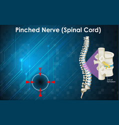 Diagram Showing Pinched Nerve