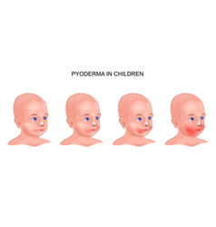 Pyoderma On The Baby S Face