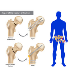 Repair Of Hip Fracture Or Fixation