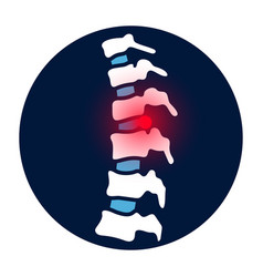 Intervertebral Hernia Concept