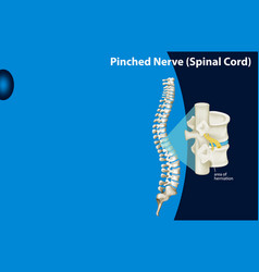 Diagram Showing Pinched Nerve