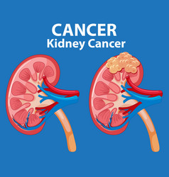 Cancer Development Process In Human Kidney