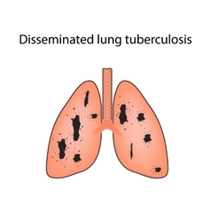 Disseminated Tuberculosis