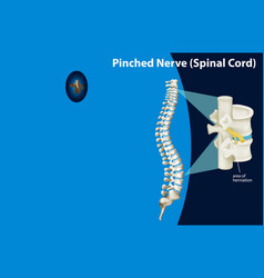 Diagram Showing Pinched Nerve