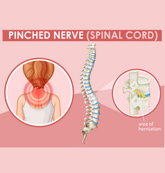 Diagram Showing Pinched Nerve In Human