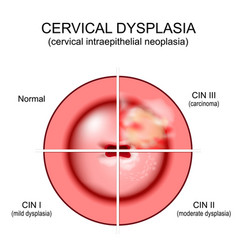 Cervical Dysplasia Close-up Of A Cervix