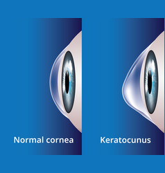 Eye Cornea And Keratoconus Disorder Medical