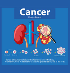 Cancer Development Process In Human Kidney An