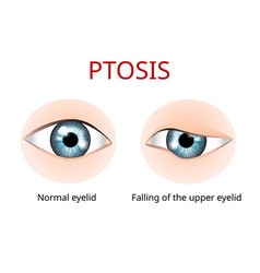 Ptosis Eyelid Eye Sickness Anatomy Eye