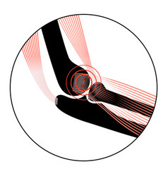 Lateral Epicondylitis Tennis Elbow