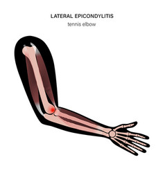 Lateral Epicondylitis Tennis Elbow