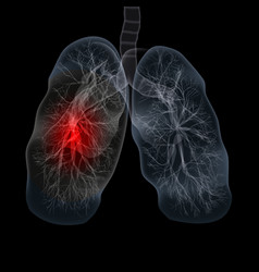 Covid-19 Computed Tomography Of The Lungs Ct Scan