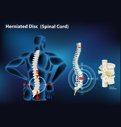 Diagram Showing Herniated Disc In Human